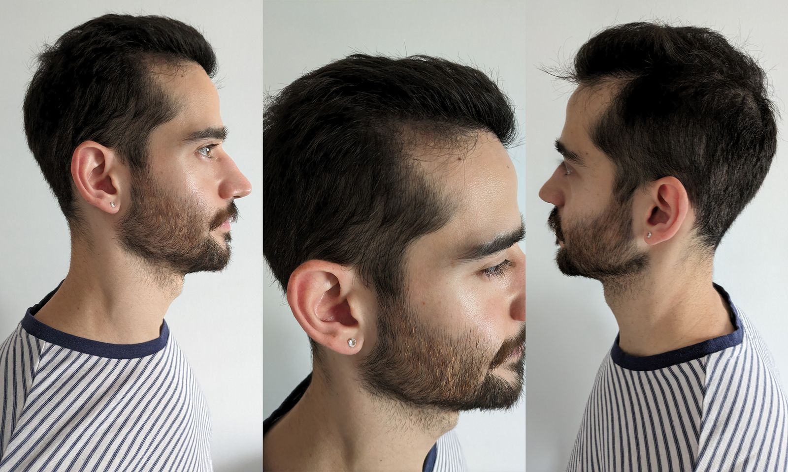 Personalized Hair Systems for Men NYC